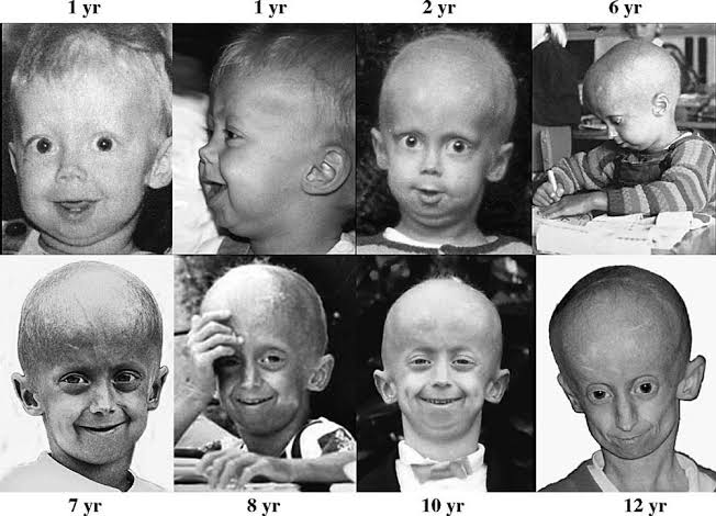 Hutchinson-Gilford Progeria Syndrome