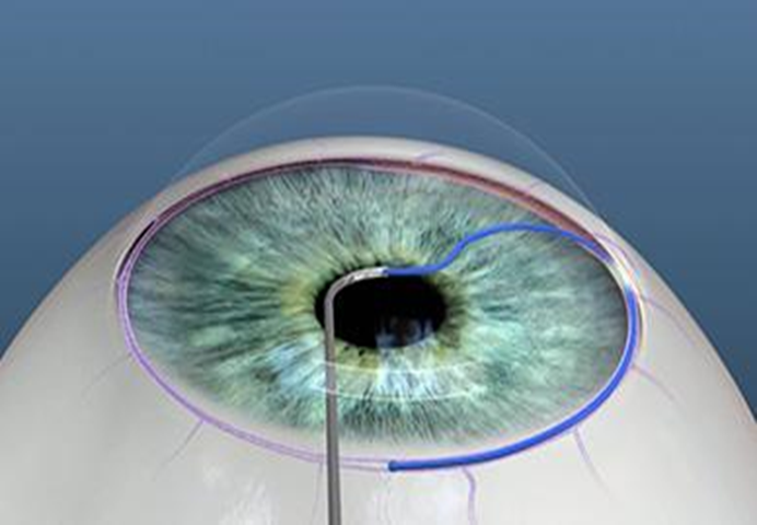 January is Glaucoma Awareness Month: Deep Dive into Eight Types of Glaucoma Surgery by a Single Surgeon