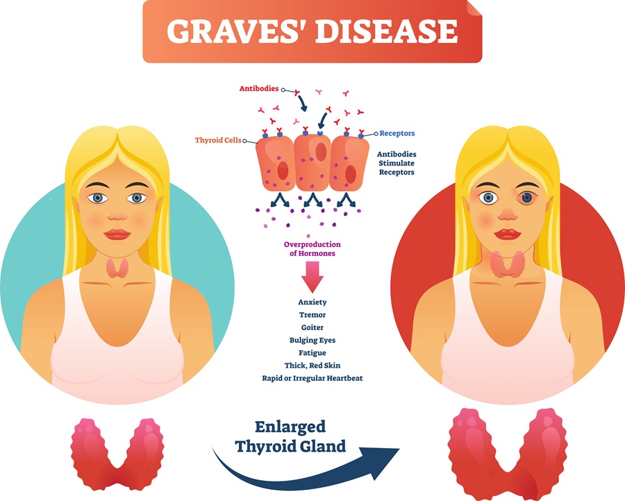 Graves' Disease Unveiled