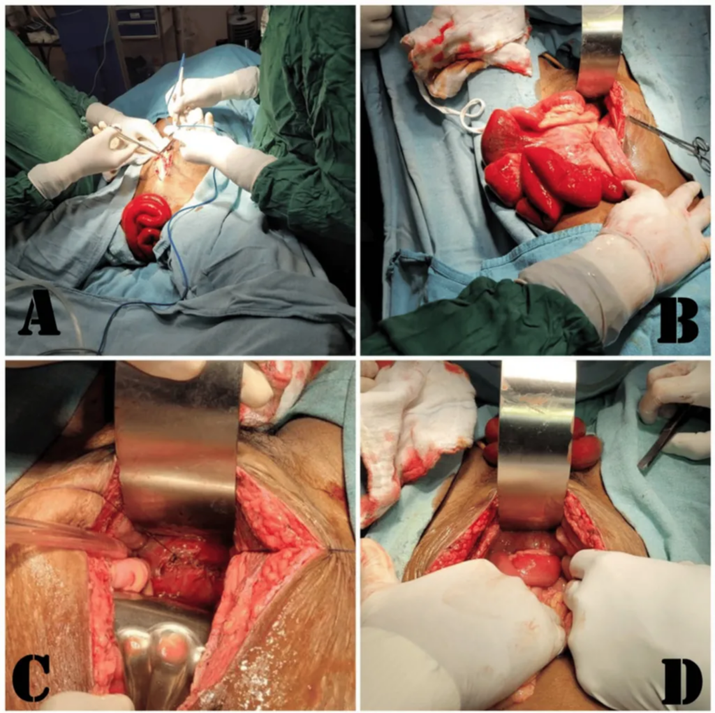 Unpredicted Outcome: The Emergence of Intestinal Prolapse After Total Abdominal Hysterectomy