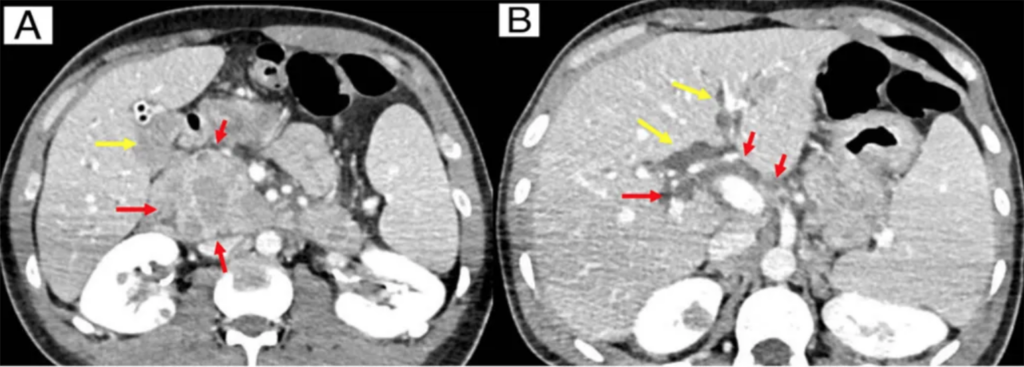 A Case of Gastric Burkitt Lymphoma in HIV/AIDS: Unusual Lymph Node Involvement Explored