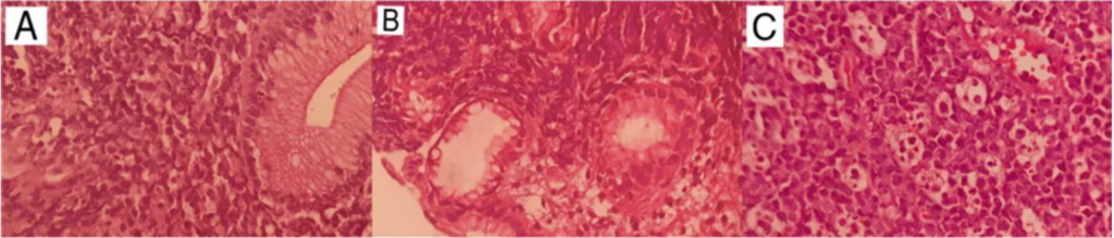 A Case of Gastric Burkitt Lymphoma in HIV/AIDS: Unusual Lymph Node Involvement Explored