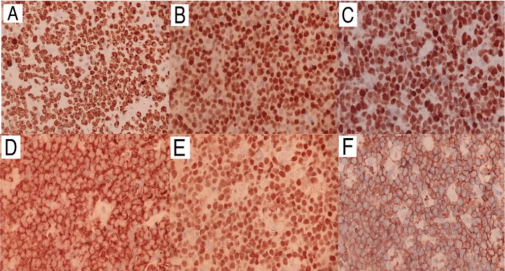 A Case of Gastric Burkitt Lymphoma in HIV/AIDS: Unusual Lymph Node Involvement Explored