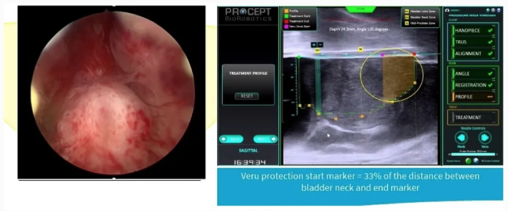 AquaBeam Surgery: King Charles and the Evolution of Minimal Invasive Procedures