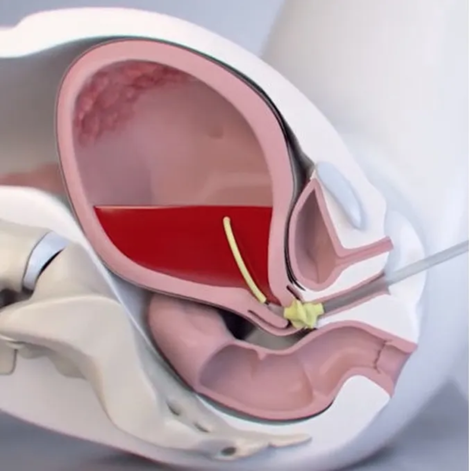 Exploring Vitamin D and Postpartum Hemorrhage: A New Perspective