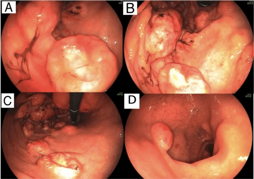 A Case of Gastric Burkitt Lymphoma in HIV/AIDS: Unusual Lymph Node Involvement Explored