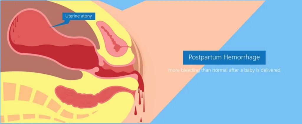 Exploring Vitamin D and Postpartum Hemorrhage: A New Perspective