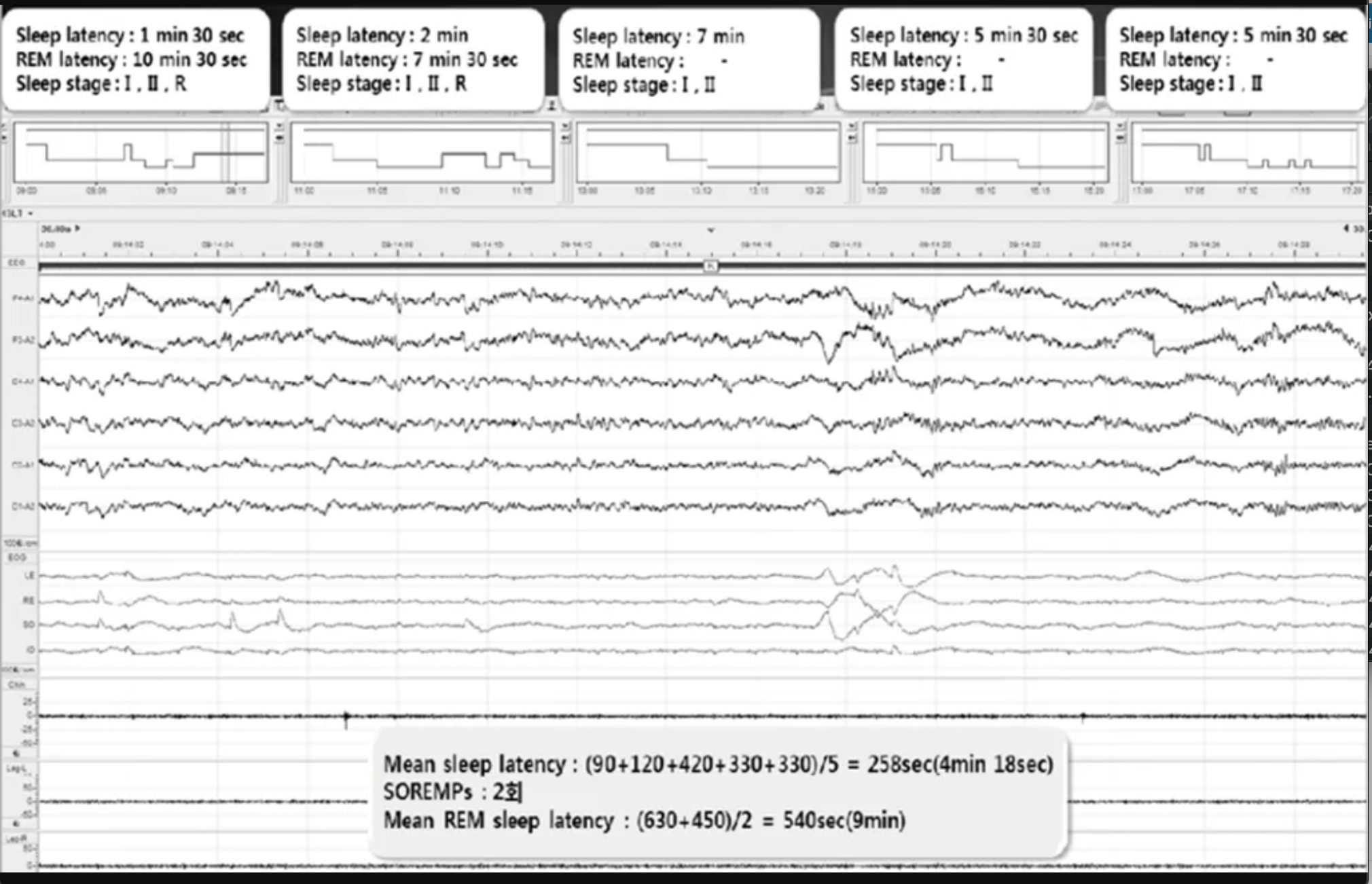 Idiopathic Hypersomnia Evaluation and Treatment | 2024