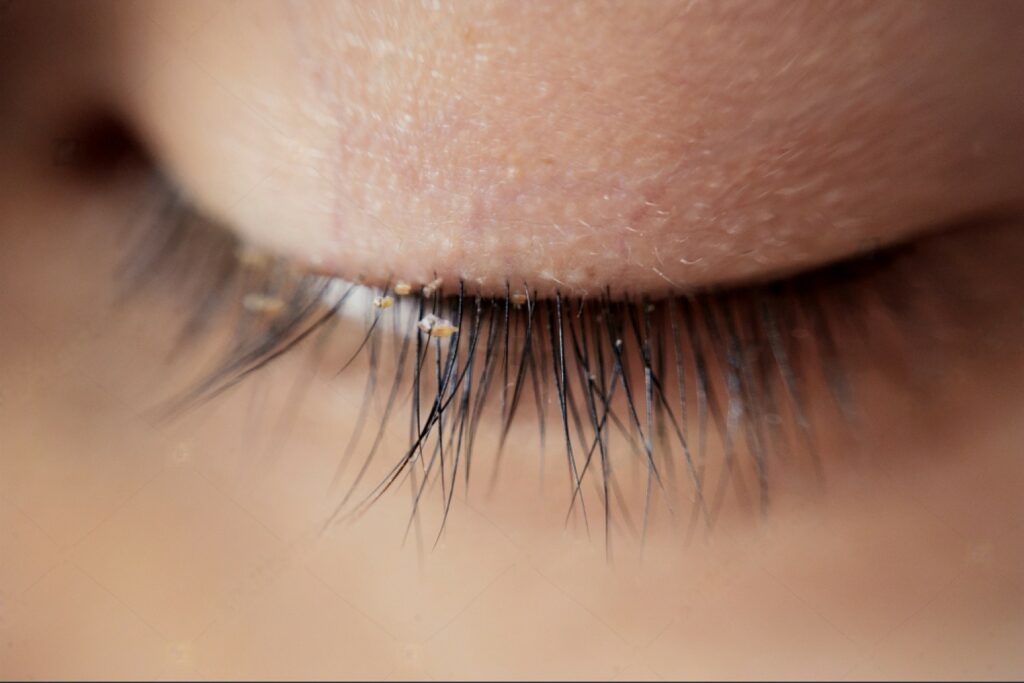 Eyelash Extensions: The Beauty Trend with Hidden Risks 